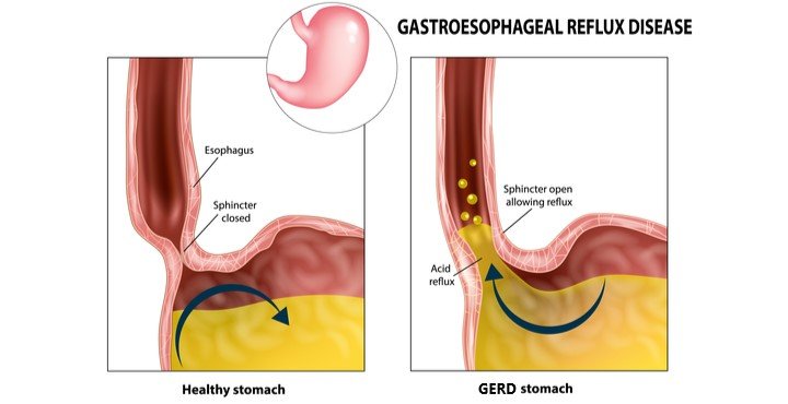 GERD: Understanding and Managing Acid Reflux GERD: Understanding and Managing Acid Reflux